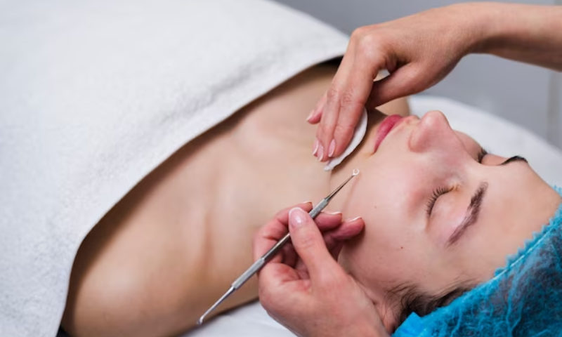 microneedling for scars