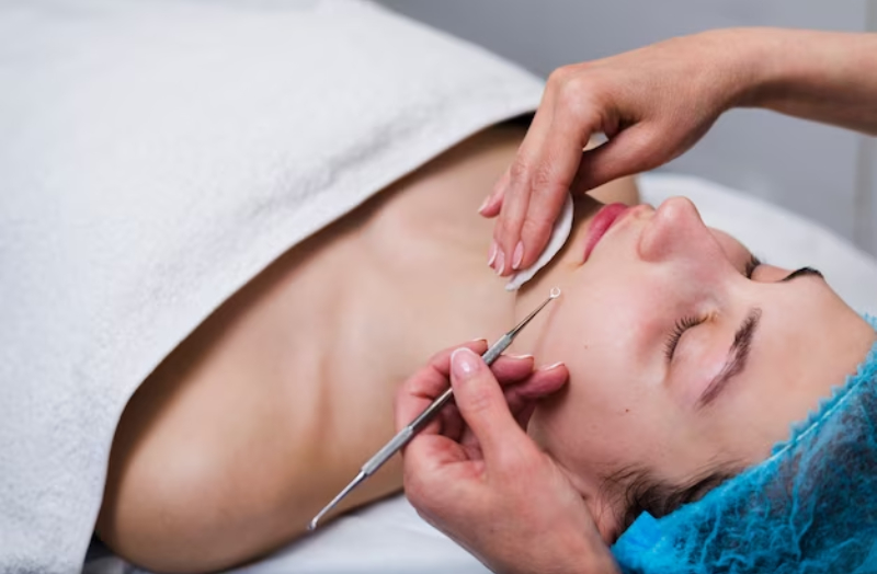 microneedling for scars