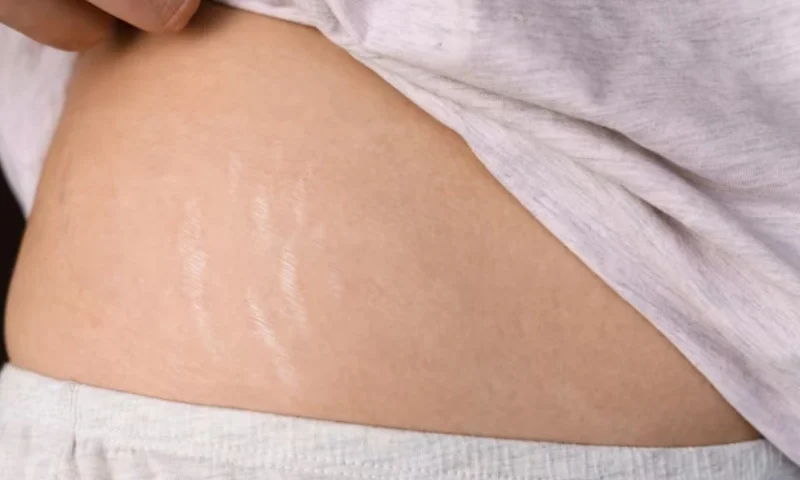 stretch mark microneedling
