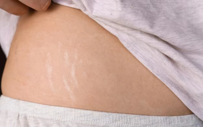 stretch mark microneedling