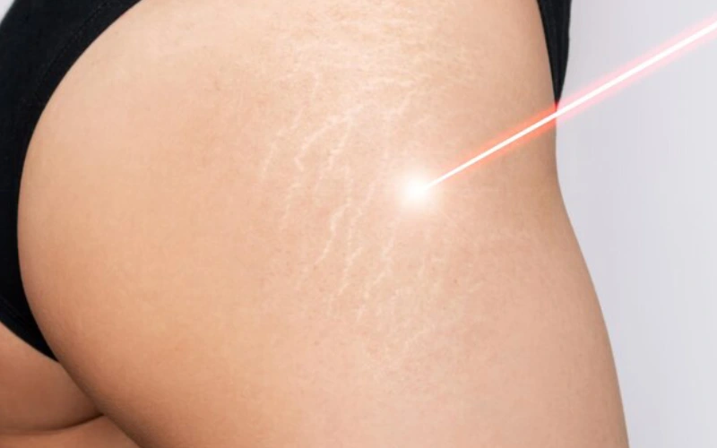 stretch mark microneedling