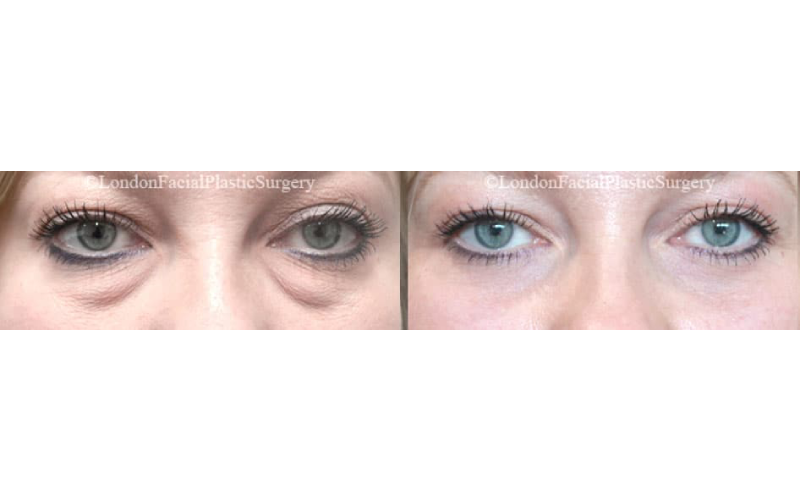eyelid surgery london