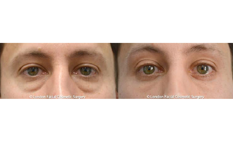eyelid surgery london