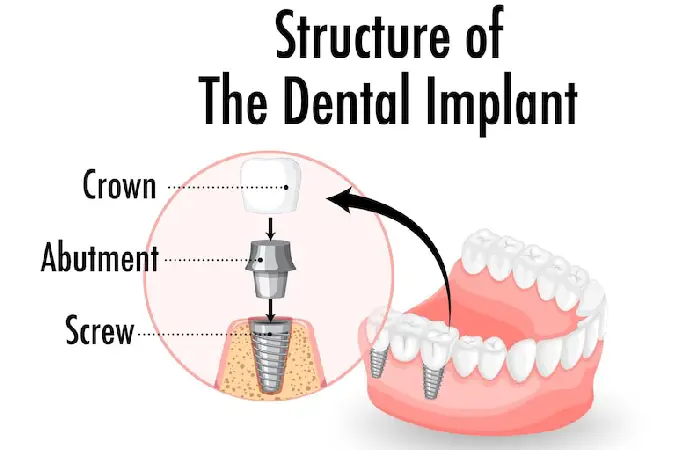 dental implants pembroke pines fl