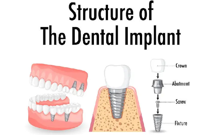 dental implants pembroke pines fl
