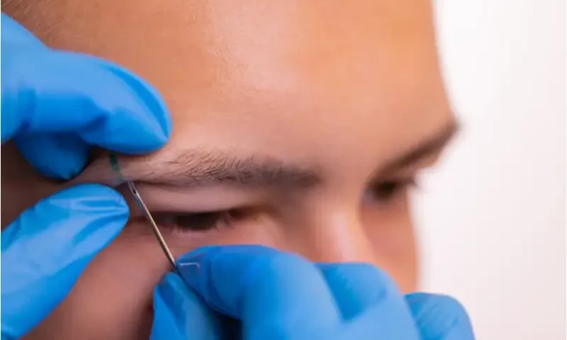 Eyebrow hair transplant in Istanbul