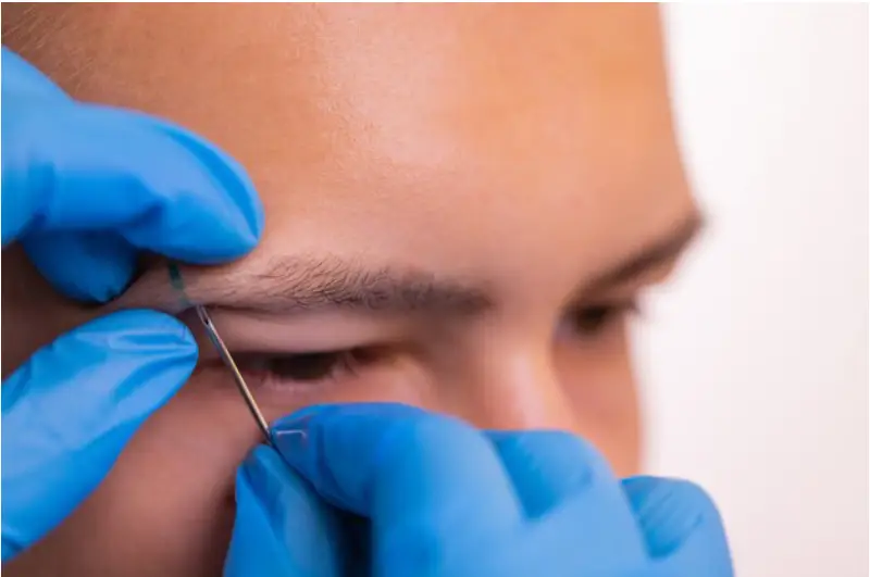 Eyebrow hair transplant in Istanbul